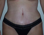 13 days post-op