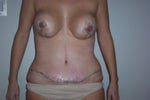 1 week post-op, front view