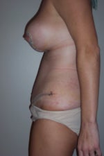 1 week post-op, I still can't stand up straight and boobs haven't dropped much