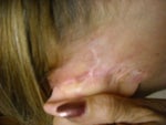 scars/bumps/stitches protruding ,left ear back