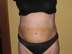1 week post op - front