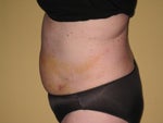 1 week post op - side