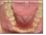 Start of treatment