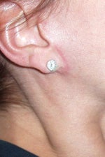 Pixie ear deformity LL caused plus ropey scarring. Both sides are the same. $16,500 to correct this.