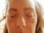 After Radiesse injection to hollows under eye-horrid-redness is gone-brown lines remain and cannot be covered completely after 1 YEAR-please be careful with this product and test beforehand, maybe tiny amounts first-worth it and wish I had...