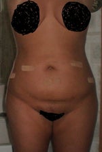 12/11/08 still swollen most discomfort is gone.