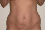 before surgery