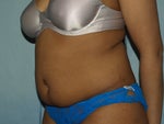 Pre-Op