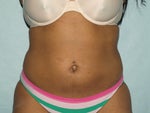Post Op 4 weeks