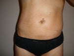 4 weeks post-op