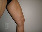 4 weeks post-op