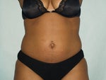 3 Months Post Op