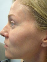 Profile with good view of lines around eyes