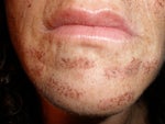 burnt chin