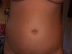 after- one week- puffy- improved