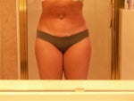 Front Day 2 (swelling has begun)