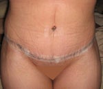 Post Tummy Tuck - Day 13