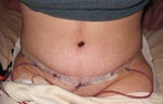 Post Tummy Tuck - Day 5