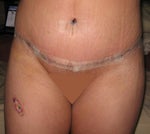Post Tummy Tuck - Day 9