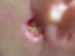 infected hole in front of left ear (after three rounds of antibiotics)