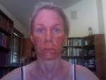 A few hours after the procedure-red and crusty