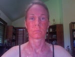 Three days after procedure-pronounced redness on neck and chest