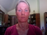Five days after procedure-still quite red, some peeling