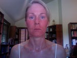 Six days after procedure-still red