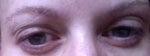 eyelid bulges like I'm crying