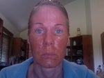 Day after procedure-still oozing, still crusty