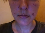 This is the 2nd day after my 2nd treatment.