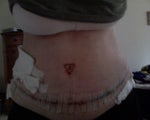 5 days after surgery