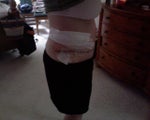 5 days after surgery