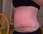 13 days after surgery, swelling down a little bit more