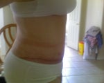 27 days after surgery