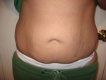 2 days before surgery