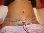 2 days after surgery! Dis not feel as bad as it looked.