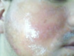 Post Procedure