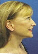 Less waddle but no ear lobes- cannnot wear earring because the piercing is no longer facing forward.
