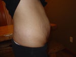 BEFORE Right Side Smartlipo MDX