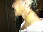 8 days after surgery