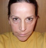 Points on the side of my face 3 months out