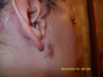 Burn (or whatever it is from) 3 months after