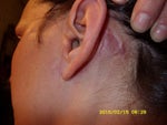Left side 3 months after