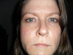 Close up, a few hours after injection. Just minor redness under one eye which was gone in two days.