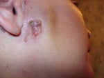 Burn 8 days after 