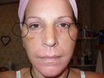 circles show what puckers look like 8 days after