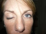 Closed eye after Botox injection