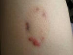 Laser treatment on hyperpigmentation