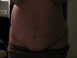 Here you can see the actual scar revision.  After having taken this picture, I am actually shocked at how swollen my belly really is.  It certainly feels this big. 